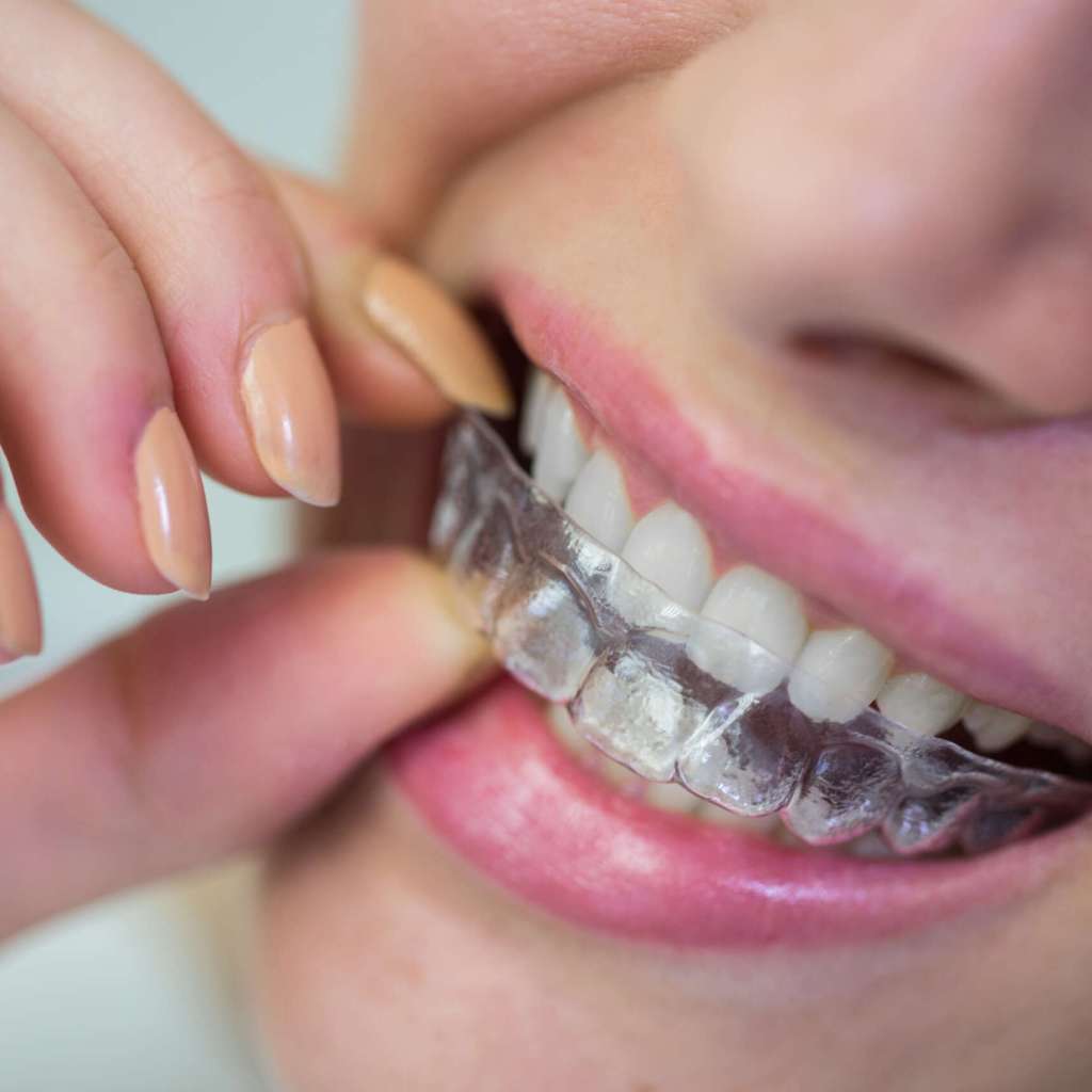 Teeth alignment